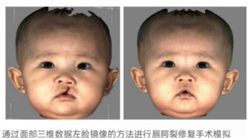 相约美容与整形学术年会｜准确重建面部三维数据，3D面部扫描技术助力医美整形1149.jpg